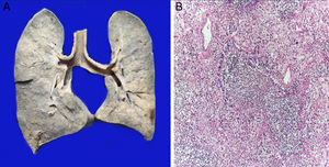 The lungs were found to be enlarged in size and weight. The surface of the cut shows areas of white consolidation (A). Histological sections show intense inflammatory infiltration of polymorphonuclear leukocytes that destroy the wall of a bronchiolum (B).