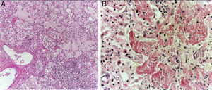 Pulmonary edema, inflammatory infiltrate of lymphocytes, and interalveolar macrophages with brown and granular appearance material (A). Diffuse alveolar damage with the formation of hyaline membranes was observed (B).