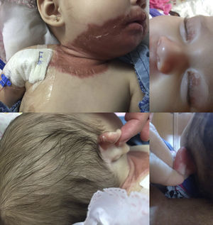 Dermal lesions at diagnosis. Disseminated dermatosis is observed in upper eyelids, perioral region, left auricular pavilion.
