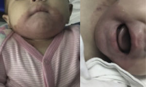 Dermal lesions after starting oral zinc administration. A remarkable improvement can be observed.