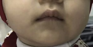 Patient with the recovery of skin lesions in follow-up consultation three months after starting treatment with zinc.