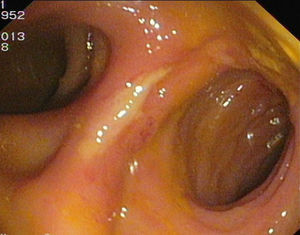 Image of an ileorectal fistula, 15cm from the anal margin, with an ulcer in one margin.