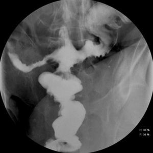 Barium enema in which spillage of contrast in three directions can be observed: left colon, ileum and blind loop.
