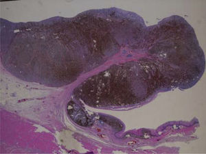 Haematoxylin–eosin staining of the endoscopic esophageal biopsy.