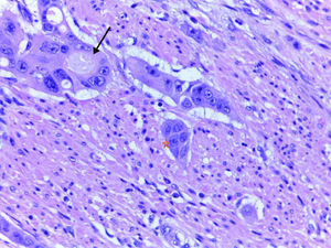 Histological section stained with haematoxylin–eosin (40×), showing neoplastic glands in a rectal adenocarcinoma (arrow) and poorly differentiated clusters (star).