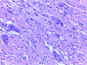 Histological sections stained with haematoxylin–eosin (40×), showing poorly differentiated clusters (stars) and tumour budding (circles).