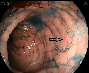 Bichromoendoscopy reveals a previously undetected lesion (0-IIa) on the posterior wall of the antrum.
