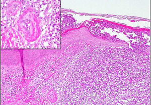 Histological section of the skin, showing an intraepidermal pustule with abundant neutrophils. Visible in the dermis is fibrinoid necrosis of small vascular structures (magnified image), consistent with pustular leukocytoclastic vasculitis.
