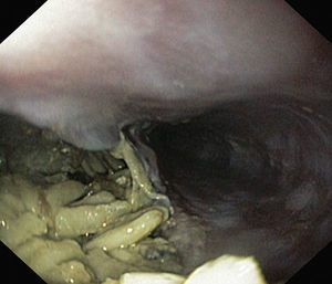 A 5cm wide esophageal perforation with a large amount of food in the mediastinum.