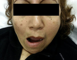 Left unilateral temporomandibular dislocation. The patient's inability to close her mouth can be observed.