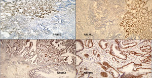 Immunohistochemical study to detect expression of the proteins associated with DNA repair genes: loss of expression of PMS2 and MLH1 in the tumour cells can be seen, while the normal mucosa retains nuclear expression of both proteins. MSH2 and MSH6 are positive in the tumour and in the normal mucosa.