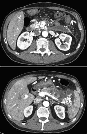 Pancreatic arteriovenous malformation affecting the pancreas head and tail, with foci of acute pancreatitis in the body and tail.