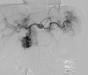 Selective arteriography of the celiac trunk: extensive areas of pathological artery filling, feeding mainly from the gastroduodenal and splenic arteries.