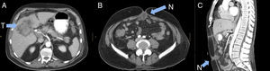Computed tomography scan: (A) hepatic tumour. (B and C) Umbilical nodule (N).
