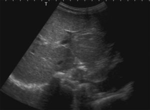 Double-duct sign, characteristic of intrahepatic biliary dilatation.