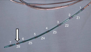 Distal end of an oesophageal intraluminal impedance catheter with a distance of 2cm between each of the 7 sensors (numbered 1–7) that define the 6 study channels (marked Z1–Z6). The pH sensor (white arrow) is situated between the last and penultimate impedance sensor.