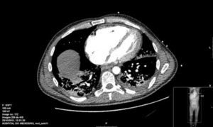 Chest angio-CT showing PHT with enlarged right chambers, left displacement of the interventricular septum, right ventricle-left ventricle ratio >2 and lymphadenopathies.