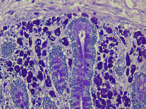 Histiocytes filled with PAS-positive Tropheryma whipplei organisms.
