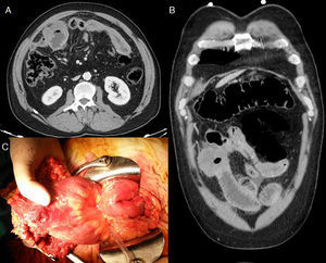 (A) Abdominal computed tomography (CT), axial slice: thickening of an ileal loop localized in the right iliac fossa causing closed-loop bowel dilatation. (B) Abdominal CT, coronal slice: pneumoperitoneum and interloop free fluid. (C) Surgical specimen: ileal segment with perforation partially contained by the greater omentum.