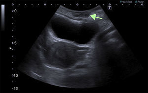 Abdominal ultrasound in which a solid, heterogeneous lesion, hypoechoic relative to muscle, can be seen in the right anterior rectus abdominis muscle.