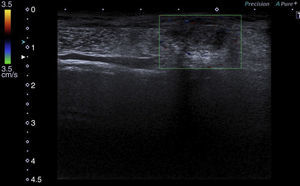 Colour Doppler ultrasound showing no Doppler signal inside the endometrioma.