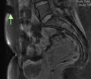 Coronal T1-weighted MRI slice, in which a 24mm×11mm lesion, hypointense relative to muscle, can be seen.