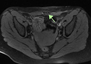 Axial fat-saturated T1-weighted MRI slice showing a hypoechoic lesion containing hyperintense images, consistent with haemorrhagic foci.