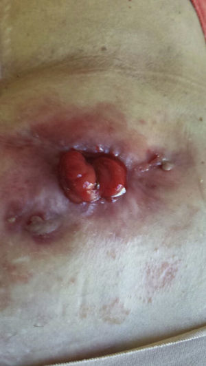 Improvement in the lesion 6 weeks after starting infliximab treatment.