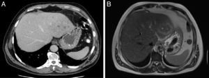 (A) Abdominal computed tomography (CT). An 8-cm hepatic lesion in segments II and III, of heterogeneous density, with confluent areas of lower density inside. (B) MRI scan of the liver. T2-weighted image, in which an isointense lesion can be observed in segments II and III, with areas with a cystic–necrotic appearance inside and perilesional oedema.