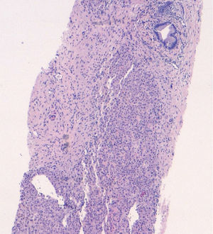 Liver at low magnification with the presence of fibrotic areas that have replaced the hepatic parenchyma and inflammatory foci (haematoxylin and eosin [H&E], 8×).