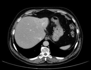 Abdominal CT scan at 6-month follow-up. Significant reduction (almost disappearance) in the size of the lesion in the left lobe of the liver.