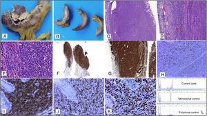 (A, B) Macroscopic appearance of the transmural intestinal infiltration by high-grade T-cell lymphoma. (C–E) Histopathology study with haematoxylin and eosin, in which transmural infiltration by high-grade non-Hodgkin lymphoma in the small intestine can be seen, 10×, 20× and 40×, respectively. (F) Immunohistochemical staining: the tumour lymphoid infiltrate is strongly and diffusely positive for CD2, 4×. (G) Tumour lymphoid infiltrate positive for CD7 with transmural intestinal involvement, 10×. (H) CD8-negative tumour cells with presence of accompanying isolated non-neoplastic CD8-positive T-lymphocytes, 10×. (I) Strongly positive CD4 staining in the tumour cells with negativity in the intestinal glands, 40×. (J) Aberrant expression of CD79a in tumour cells of a T-cell lymphoma, 40×. (K) Nuclear overexpression of cyclin D1 in tumour cells, 40×. (L) Molecular biology study in which a monoclonal T-cell population can be observed.