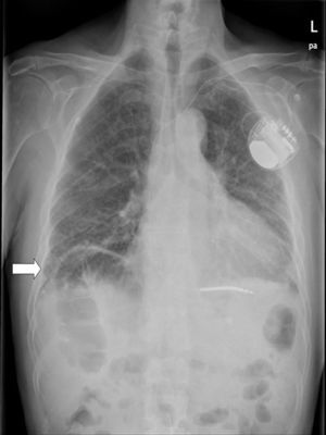 Interposition of the intestine between the liver and right hemidiaphragm in an asymptomatic patient. Haustra can be observed (white arrow). Findings consistent with Chilaiditi sign.