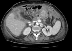 Computed tomography angiogram. The arrow points to a pseudoaneurysm of the superior mesenteric artery.