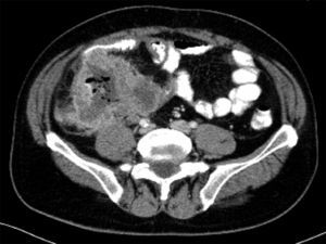 Abdominal computed tomography, with oral and intravenous contrast. A large mass measuring 10.2×8.8cm can be seen in the right iliac fossa, affecting the terminal ileum and adjacent distal ileal loops; it also appears to encompass the appendix, with lateral displacement of the caecum. The inside of the mass shows fluid and oral contrast content, with air bubbles, probably due to necrosis and ulceration.