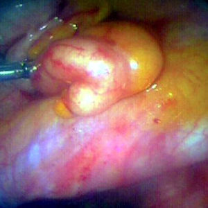 Irregular, distended and inflamed appendix.