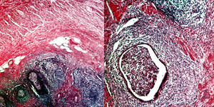 Endometrial glands and stroma in the seromuscular layer of the appendix.