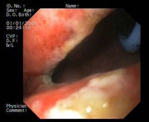 Gastroscopy showing the presence of the external drainage tube in the dehiscence.