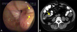 (A) Deformity of the ileocaecal valve with ulcers (arrows). (B) Thickening of the terminal ileum (arrow).