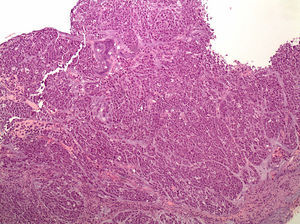 Diffuse gastric cancer. Multiple tumour foci, with signet ring cells, spread throughout the gastric mucosa. (Photo courtesy of Miriam Cuatrecasas).