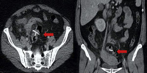Computed tomography images, in which the arrows indicate the location of the intrauterine device in the abdominal cavity.
