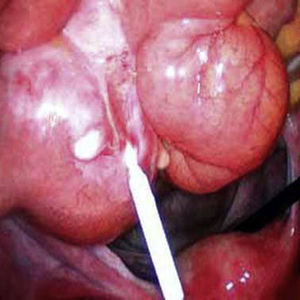 Intrauterine device embedded in the small intestine, observed during the laparoscopy.