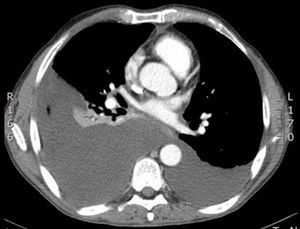 Right pleural effusion occupying 45% of the right hemithorax and a small left pleural effusion.