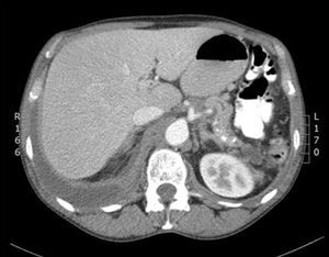 Pancreas with calcifications in the tail, body and uncinate process with discreet dilation of the duct of Wirsung.