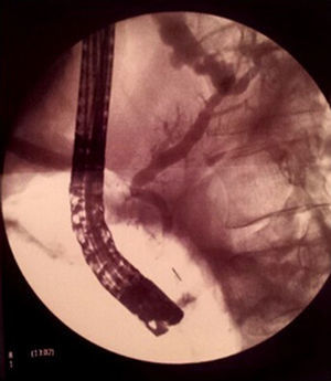 The ERCP shows the presence of a fistula at the level of the pancreatic tail.