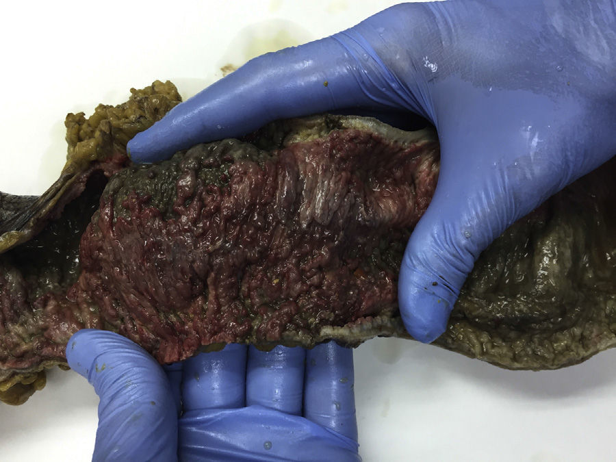 Fulminant Clostridium difficile colitis | Gastroenterología y ...