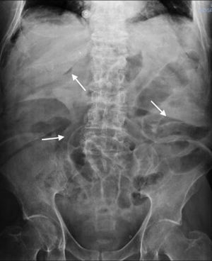 Plain abdominal X-ray: the double wall sign and pneumoperitoneum can be seen.