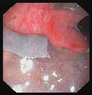 Sigmoid colon wall, showing detachment of the ischaemic mucosa, revealing a bloody wall.