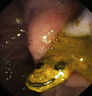 A odd-looking and elongated foreign body removed from the common bile duct.