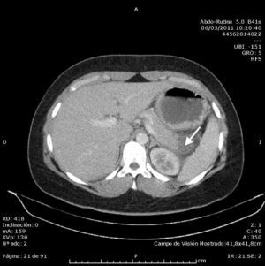 Computed tomography image of the abdomen and pelvis, in which an area of low uptake can be seen in the tail of the pancreas with rarefaction of the adjacent fat, consistent with focal pancreatitis (white arrow).